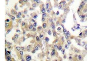 Immunohistochemistry analyzes of Vimentin antibody in paraffin-embedded human breast carcinoma tissue. (Vimentin anticorps)