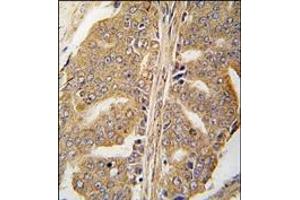 Formalin-fixed and paraffin-embedded human prostata carcinoma tissue reacted with Paxillin Antibody, which was peroxidase-conjugated to the secondary antibody, followed by DAB staining.