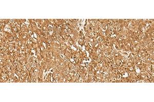 Immunohistochemistry of paraffin-embedded Human ovarian cancer tissue using GMEB2 Polyclonal Antibody at dilution of 1:35(x200)