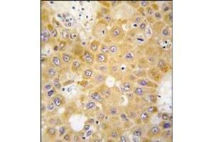 Formalin-fixed and paraffin-embedded human hepatocarcinoma tissue reacted with APH1 antibody (N-term), which was peroxidase-conjugated to the secondary antibody, followed by DAB staining. (APH1A anticorps  (N-Term))