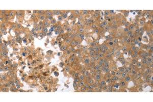 Immunohistochemistry of paraffin-embedded Human breast cancer tissue using MMP27 Polyclonal Antibody at dilution 1:50 (MMP27 anticorps)