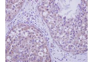 IHC-P Image Immunohistochemical analysis of paraffin-embedded human breast cancer, using LIM kinase 2, antibody at 1:250 dilution. (LIMK2 anticorps)