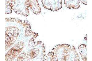 Formalin-fixed, paraffin-embedded human Colon Carcinoma stained with Villin Mouse Monoclonal Antibody (VIL1/1314 + VIL1/2376). (Villin 1 anticorps  (AA 179-311))