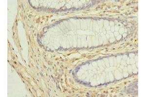 Immunohistochemistry of paraffin-embedded human colon cancer using ABIN7149138 at dilution of 1:100
