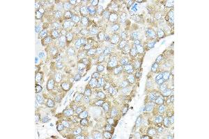 Immunohistochemistry of paraffin-embedded human liver cancer using HSP90B1 Rabbit pAb (ABIN6130434, ABIN6142031, ABIN6142033 and ABIN7101795) at dilution of 1:50 (40x lens). (GRP94 anticorps  (AA 550-650))
