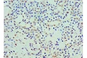 Immunohistochemistry of paraffin-embedded human breast cancer using ABIN7142608 at dilution of 1:100