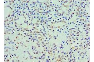 Immunohistochemistry of paraffin-embedded human breast cancer using ABIN7142608 at dilution of 1:100 (Coq7 anticorps  (AA 37-217))