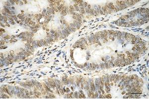 Immunohistochemistry was performed on paraffin-embedded human sigmoid colon carcinoma using histone H3 (mono methyl K14) antibody (ABIN7798958), 1:200). (Recombinant Histone 3 anticorps  (H3K14me1))