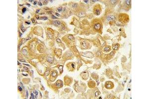IHC analysis of FFPE human lung carcinoma tissue stained with TLR2 antibody (TLR2 anticorps  (AA 212-242))