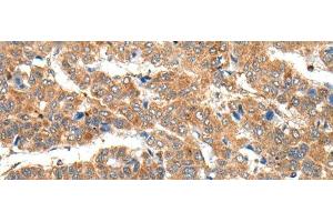 Immunohistochemistry of paraffin-embedded Human liver cancer tissue using RPL14 Polyclonal Antibody at dilution of 1:30(x200)