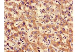 Immunohistochemistry of paraffin-embedded human liver cancer using ABIN7169266 at dilution of 1:100 (PPP2CA anticorps  (Catalytic Subunit alpha))