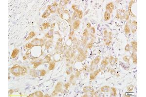 Formalin-fixed and paraffin embedded human liver carcinoma labeled with Anti-Phospho-PRAS40 (Thr246) Polyclonal Antibody, Unconjugated (ABIN744953) at 1:200 followed by conjugation to the secondary antibody and DAB staining (PRAS40 anticorps  (pThr246))
