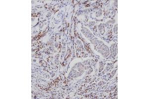 Immunohistochemical analysis of A on paraffin-embedded Human breast carcinoma tissue.