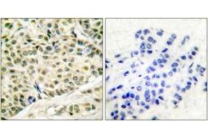 Immunohistochemistry analysis of paraffin-embedded human breast carcinoma tissue, using MCM2 Antibody.