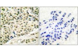 Immunohistochemistry analysis of paraffin-embedded human breast carcinoma tissue, using MCM2 Antibody. (MCM2 anticorps  (AA 1-50))