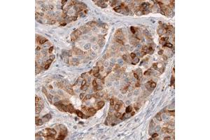 Immunohistochemical staining (Formalin-fixed paraffin-embedded sections) of human breast cancer with HMGCR monoclonal antibody, clone CL0260  shows moderate to strong cytoplasmic immunoreactivity in tumor cells.