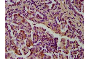 IHC image of ABIN7148987 diluted at 1:400 and staining in paraffin-embedded human lung cancer performed on a Leica BondTM system.