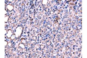 The image on the left is immunohistochemistry of paraffin-embedded Human thyroid cancer tissue using ABIN7131190(SRPK3 Antibody) at dilution 1/20, on the right is treated with fusion protein. (SRPK3 anticorps)