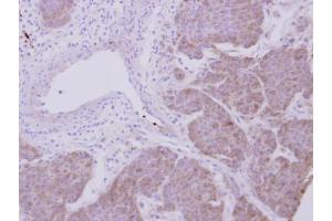 IHC-P Image Immunohistochemical analysis of paraffin-embedded human breast cancer, using Peroxiredoxin 2, antibody at 1:500 dilution. (Peroxiredoxin 2 anticorps)