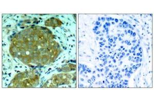 Immunohistochemical analysis of paraffin-embedded human breast carcinoma tissue, using NFκB-p105/p50 (phospho-Ser932) antibody (E011251). (NFKB1 anticorps  (pSer932))