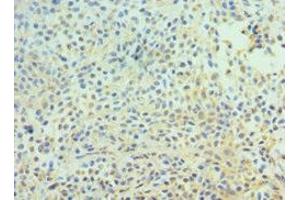 Immunohistochemistry of paraffin-embedded human breast cancer using ABIN7147301 at dilution of 1:100