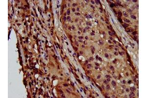 IHC image of ABIN7158792 diluted at 1:600 and staining in paraffin-embedded human lung cancer performed on a Leica BondTM system. (LAPTM4B anticorps  (AA 174-226))