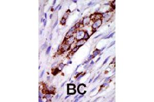 Formalin-fixed and paraffin-embedded human cancer tissue reacted with GRK5 polyclonal antibody  , which was peroxidase-conjugated to the secondary antibody, followed by DAB staining . (GRK5 anticorps  (C-Term))