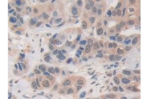 Detection of USP7 in Human Breast cancer Tissue using Polyclonal Antibody to Ubiquitin Specific Peptidase 7 (USP7)