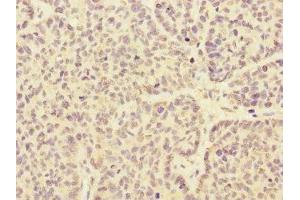 Immunohistochemistry of paraffin-embedded human ovarian cancer using ABIN7167981 at dilution of 1:100 (ARHGEF3 anticorps  (AA 287-526))