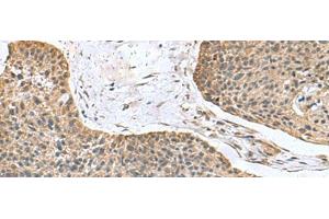 Immunohistochemistry of paraffin-embedded Human esophagus cancer tissue using NFS1 Polyclonal Antibody at dilution of 1:100(x200) (NFS1 anticorps)