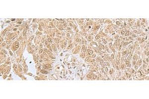 Immunohistochemistry of paraffin-embedded Human lung cancer tissue using PHF6 Polyclonal Antibody at dilution of 1:85(x200) (PHF6 anticorps)
