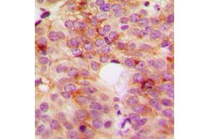 Immunohistochemical analysis of ACOT8 staining in human breast cancer formalin fixed paraffin embedded tissue section.