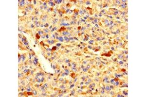 Immunohistochemistry of paraffin-embedded human melanoma using ABIN7176271 at dilution of 1:100 (ZNF384 anticorps  (AA 1-245))