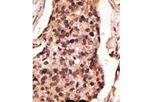 Formalin-fixed and paraffin-embedded human cancer tissue reacted with the primary antibody, which was peroxidase-conjugated to the secondary antibody, followed by DAB staining.