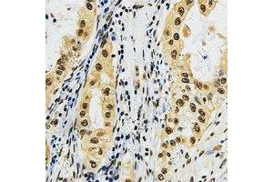 Immunohistochemical analysis of LMO3 staining in human lung cancer formalin fixed paraffin embedded tissue section. (LMO3 anticorps  (C-Term))