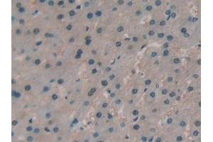 Detection of PRSS1 in Human Liver cancer Tissue using Polyclonal Antibody to Protease, Serine 1 (PRSS1) (PRSS1 anticorps  (AA 51-228))