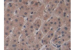 Detection of FZD1 in Human Liver cancer Tissue using Polyclonal Antibody to Frizzled Homolog 1 (FZD1) (FZD1 anticorps  (AA 117-322))