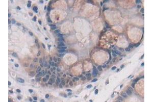 Detection of ATP6AP2 in Human Stomach cancer Tissue using Polyclonal Antibody to ATPase, H+ Transporting, Lysosomal Accessory Protein 2 (ATP6AP2)