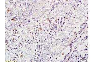 Formalin-fixed and paraffin embedded human esophageal carcinoma tissue labeled with Anti-CD86/B7-2 Polyclonal Antibody , Unconjugated at 1:200 followed by conjugation to the secondary antibody and DAB staining