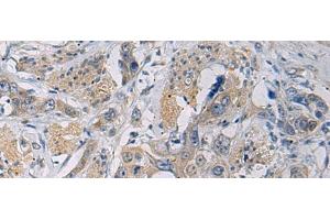 Immunohistochemistry of paraffin-embedded Human esophagus cancer tissue using CYTIP Polyclonal Antibody at dilution of 1:50(x200) (CYTIP anticorps)