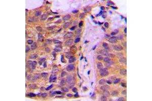 Immunohistochemical analysis of 14-3-3 zeta staining in human breast cancer formalin fixed paraffin embedded tissue section. (14-3-3 zeta anticorps  (Center))