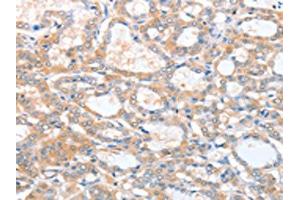The image on the left is immunohistochemistry of paraffin-embedded Human thyroid cancer tissue using ABIN7128218(ACY3 Antibody) at dilution 1/25, on the right is treated with fusion protein. (Aminoacylase 3 anticorps)