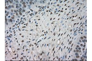 Immunohistochemical staining of paraffin-embedded Adenocarcinoma of colon tissue using anti-NTRK3mouse monoclonal antibody. (NTRK3 anticorps)
