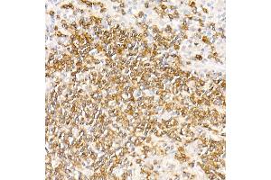 Immunohistochemistry of paraffin-embedded Human nodular Hodgkin lymphoma using CD79a antibody (ABIN7265805) at dilution of 1:100 (40x lens). (CD79a anticorps)