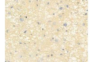 ABIN6257174 and ABIN6275113 at 1/100 staining human astrocytoma by IHC-P. (Epsin 2 anticorps  (Internal Region))