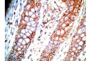Human colon cancer tissue was stained by Rabbit Anti-GLP-1 (2-24) (Human) Antibody