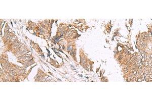 Immunohistochemistry of paraffin-embedded Human colorectal cancer tissue using HLA-E Polyclonal Antibody at dilution of 1:50(x200) (HLA-E anticorps)