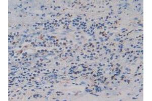 IHC-P analysis of Human Prostate Gland Cancer Tissue, with DAB staining. (IGFBP4 anticorps  (AA 22-258))