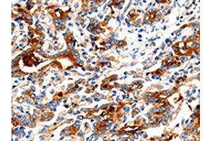 The image on the left is immunohistochemistry of paraffin-embedded Human gastric cancer tissue using ABIN7130018(KLK15 Antibody) at dilution 1/15, on the right is treated with fusion protein.