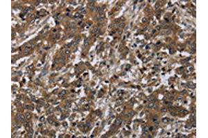 The image on the left is immunohistochemistry of paraffin-embedded Human liver cancer tissue using ABIN7191253(LAIR2 Antibody) at dilution 1/20, on the right is treated with synthetic peptide.